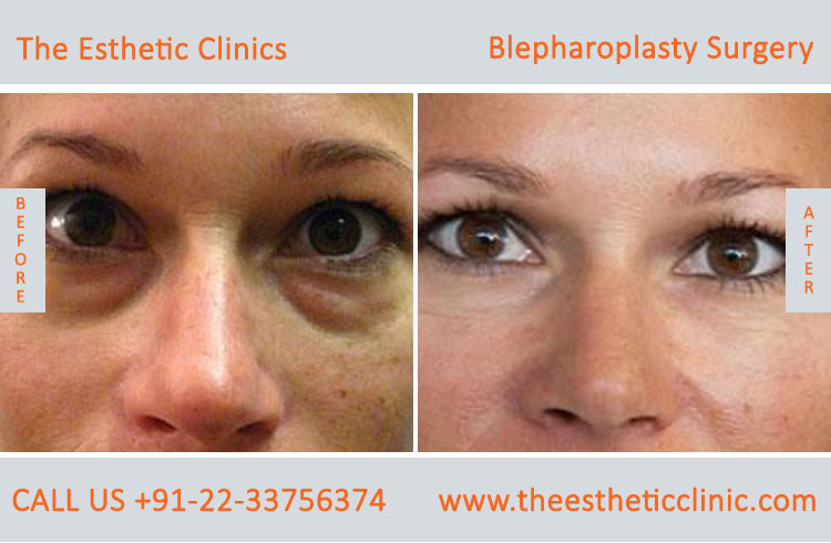 Blepharoplasty Surgery, Eyelid lift surgery before after photos in mumbai india (5)